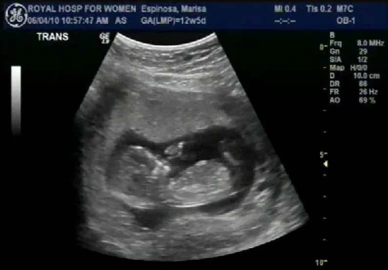 Ecografia de 1 mes embarazo - Imagui