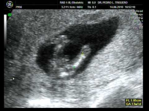 Eco 12 semanas donde se ve que es niña - Imagui