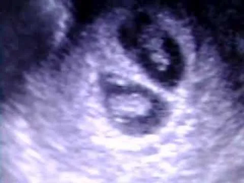 Eco de 7 semanas - YouTube