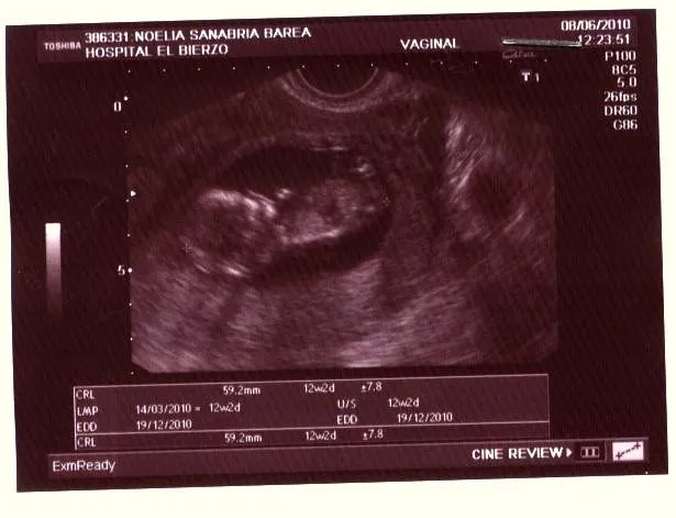 ECOGRAFÍA DE 12 SEMANAS... | EL DESPACHO DE MAMÁ ECOGRAFÍA DE 12 SEMANAS... | EL DESPACHO DE MAMÁ