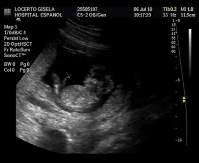 Imágenes de ecografías de 6 semanas - Imagui