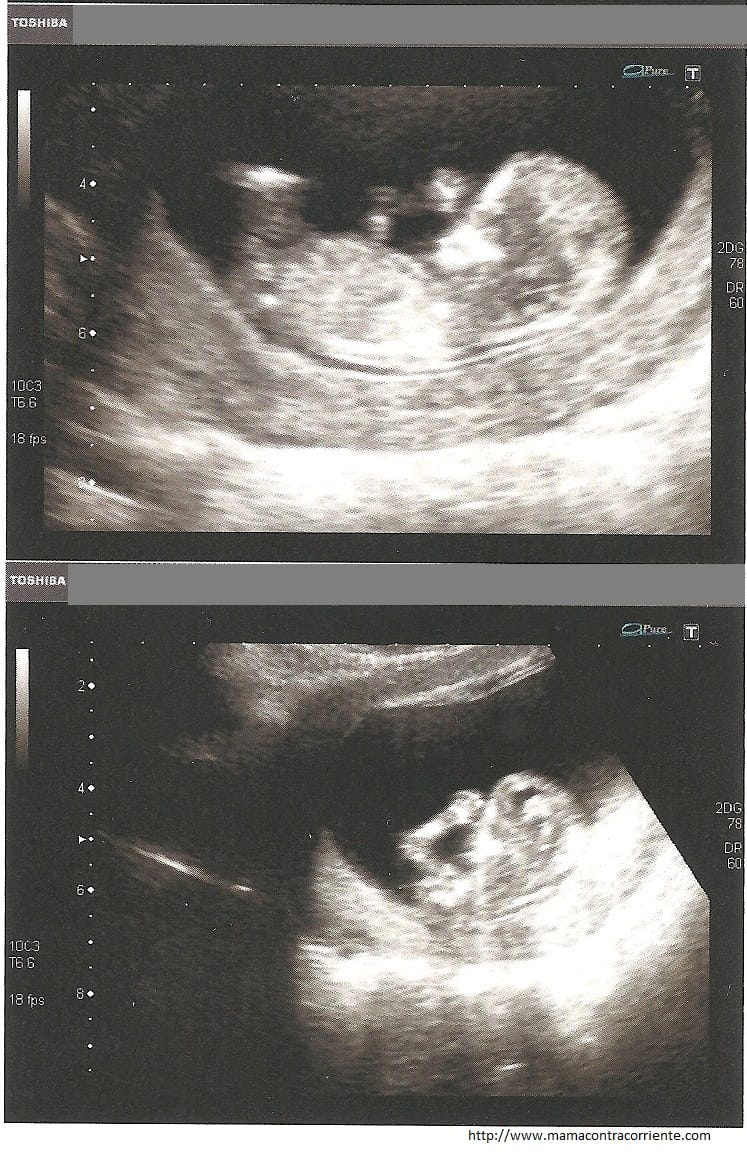 Ecografía 12 semanas - Mamá (contra) corriente Ecografía 12 semanas - Mamá (contra) corriente