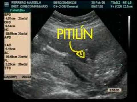 Ecografia de 12 semanas niño o niña - Imagui