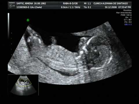 Ecografía 13 Semanas - YouTube