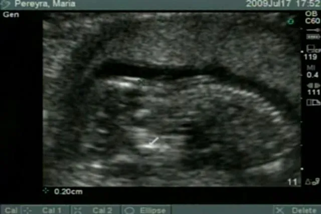 Ecografia de 14 semanas on Vimeo