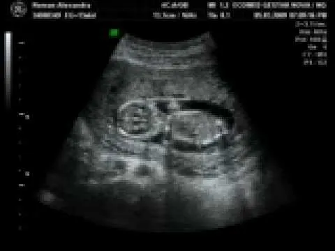 ecografia 14 semanas sanzana roman - YouTube ecografia 14 semanas sanzana roman - YouTube