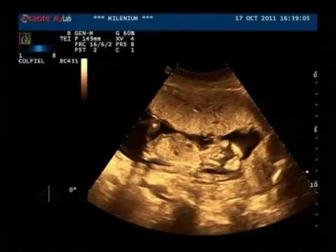 ECOGRAFIA 15 SEMANAS NIÑO - YouTube