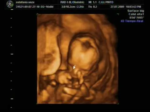 Ecografia 16 semanas 4D y 2D. Ultrasound Irati - YouTube