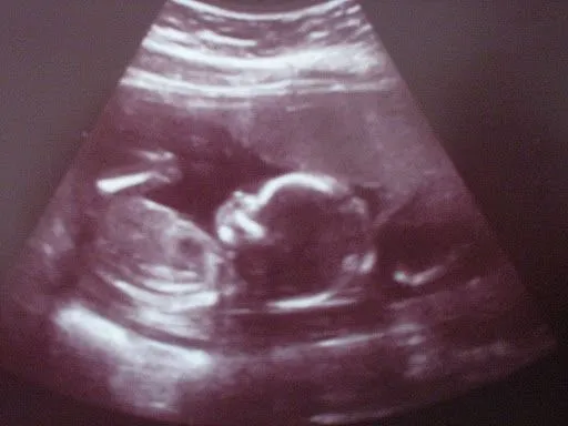 Ecografía 16 semanas, la niña.De perfil, se puede ver el femur ... Ecografía 16 semanas, la niña.De perfil, se puede ver el femur ...