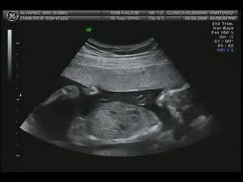 Ecografía 17 semanas Mellizos Niño Álvarez-Campana Parte I - YouTube Ecografía 17 semanas Mellizos Niño Álvarez-Campana Parte I - YouTube