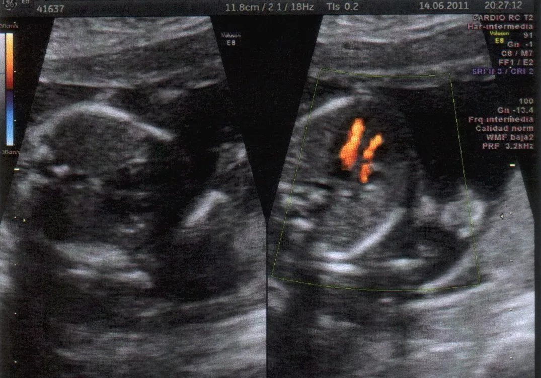 Nueva ecografía (17,5 semanas). Soy chicooooo | El blog de David y ... Nueva ecografía (17,5 semanas). Soy chicooooo | El blog de David y ...