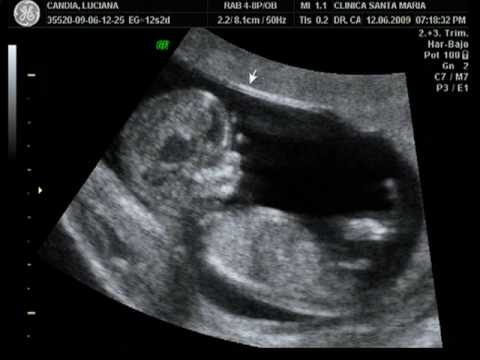 Ecografia 4D Embarazo de 15 semanas varón 4D Dr. Rafael Ortega ...