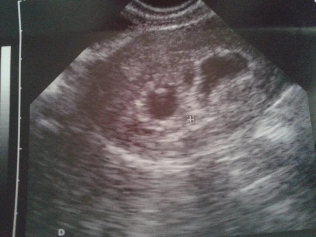 primera ecografia (2) | Tener un bebé es facilisimo.