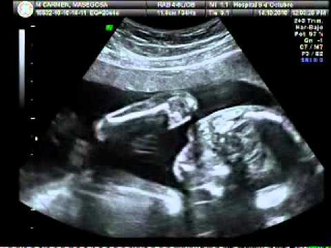 Ecografía 20 semanas y 4 días - YouTube