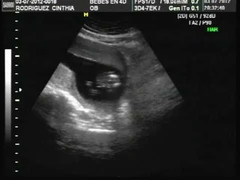 Ecografía 2D 4D Dr Rivera 15,6 semanas - YouTube Ecografía 2D 4D Dr Rivera 15,6 semanas - YouTube