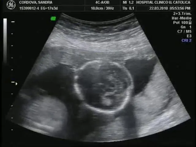 Imagen de una ecografia de 3 meses - Imagui Imagen de una ecografia de 3 meses - Imagui