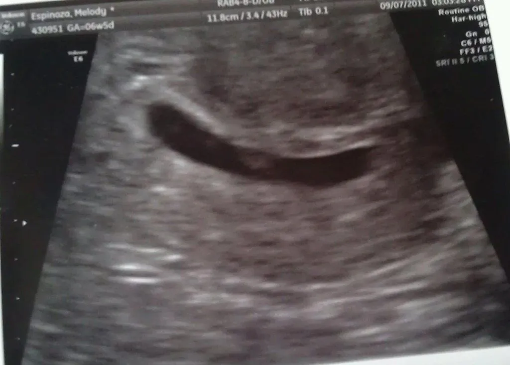 primeras ecografias (2) | Tener un bebé es facilisimo.
