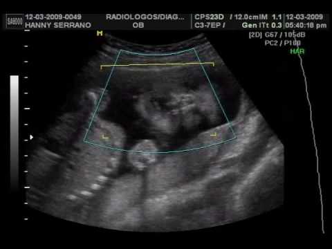 Ecografia 3D-4D 23 semanas - YouTube