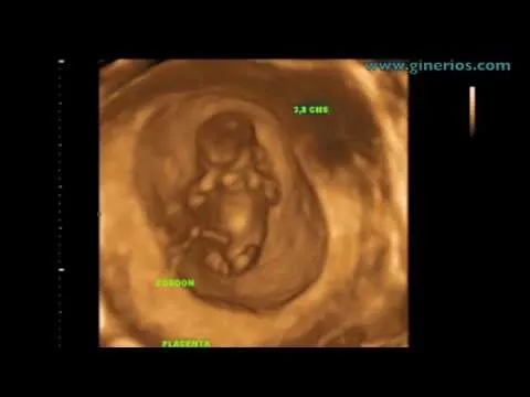 ECOGRAFIA 3D 4D PRIMER TRIMESTRE EMBARAZO - Dr. Ríos Alta ... ECOGRAFIA 3D 4D PRIMER TRIMESTRE EMBARAZO - Dr. Ríos Alta ...