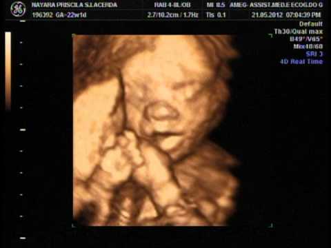 Ecografia 3D/4D 22 semanas Leandro Rocha - YouTube Ecografia 3D/4D 22 semanas Leandro Rocha - YouTube