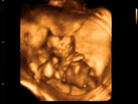 Ecografía 4D gemelos 14 semanas Ecobaby Málaga 952 22 11 29 - YouTube Ecografía 4D gemelos 14 semanas Ecobaby Málaga 952 22 11 29 - YouTube
