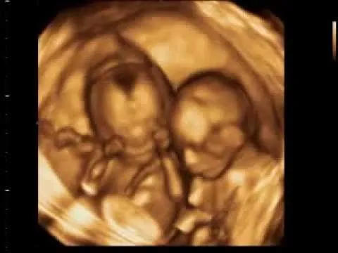 Ecografía 4D mellizos 17 semanas Ecobaby Málaga - YouTube Ecografía 4D mellizos 17 semanas Ecobaby Málaga - YouTube