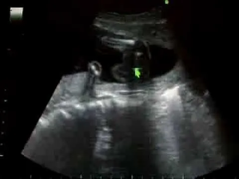 Ecografia 5meses nena - YouTube