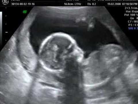 Ecografia Arnau 18 semanas - YouTube