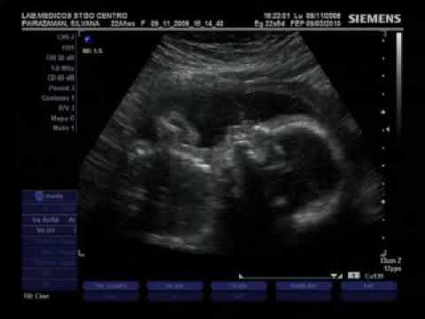 Ecografia Axel Ignacio 23 semanas - YouTube Ecografia Axel Ignacio 23 semanas - YouTube