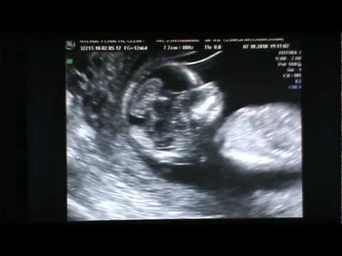 Ecografia de mi Bebe - 11 Semanas Gestacion - YouTube Ecografia de mi Bebe - 11 Semanas Gestacion - YouTube