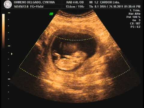 Ecografia de bebe con 12 semanas de gestacion con imagenes en 4d ...