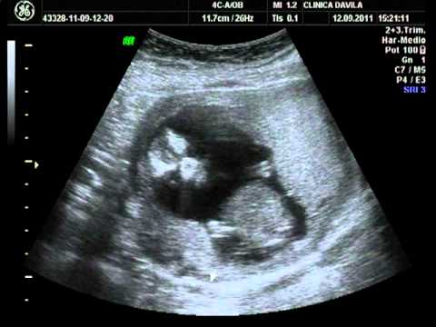 Ecografía de mi Bebé a las 15 semanas de gestación - YouTube Ecografía de mi Bebé a las 15 semanas de gestación - YouTube