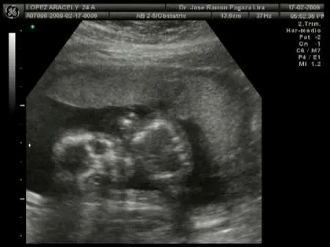 ECOGRAFIA DE NUESTRO BEBE A 18 SEMANAS DE EMBARAZO - YouTube ECOGRAFIA DE NUESTRO BEBE A 18 SEMANAS DE EMBARAZO - YouTube