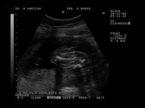 ecografia mi bebe 22 semanas y 1 dia (5 meses y medio) - YouTube ecografia mi bebe 22 semanas y 1 dia (5 meses y medio) - YouTube