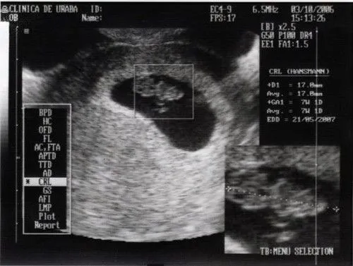 Ecografia del bebe a las 5 semanas y media | Flickr - Photo Sharing! Ecografia del bebe a las 5 semanas y media | Flickr - Photo Sharing!