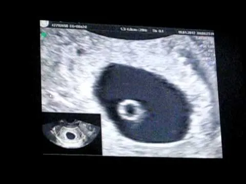 Ecografia de un bebe de 5 semanas - YouTube Ecografia de un bebe de 5 semanas - YouTube