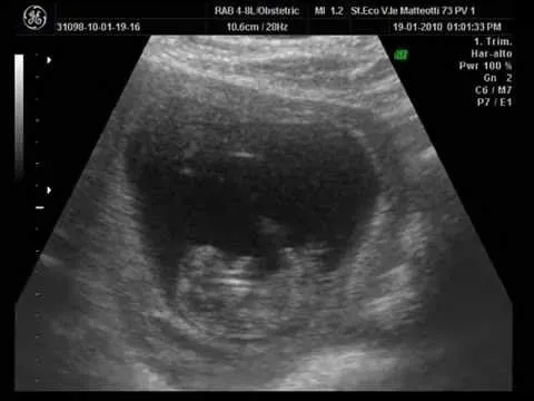 ecografia de mi bebe..."mi primogenito" 2 meses y 1/2 - YouTube ecografia de mi bebe..."mi primogenito" 2 meses y 1/2 - YouTube