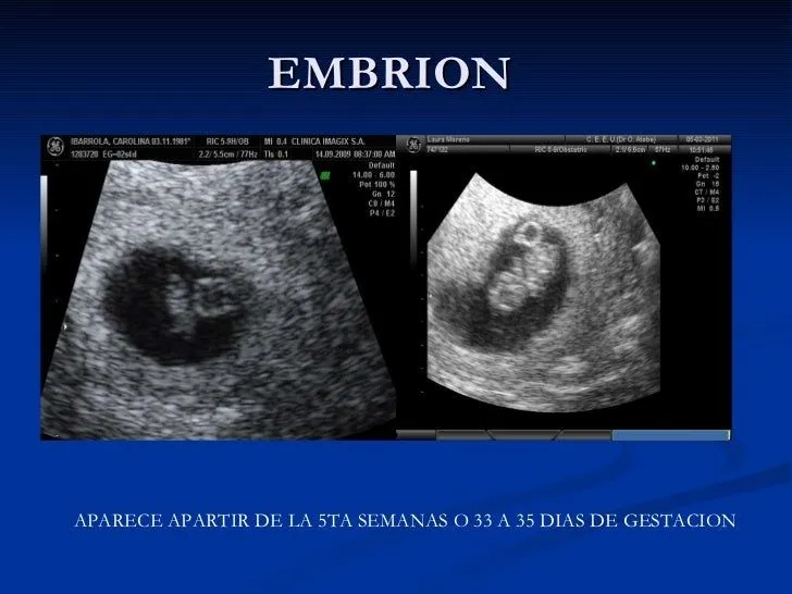 ecografia-del-primer-trimestre ...
