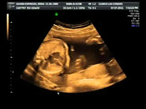 ecografia doppler 22 semanas - YouTube