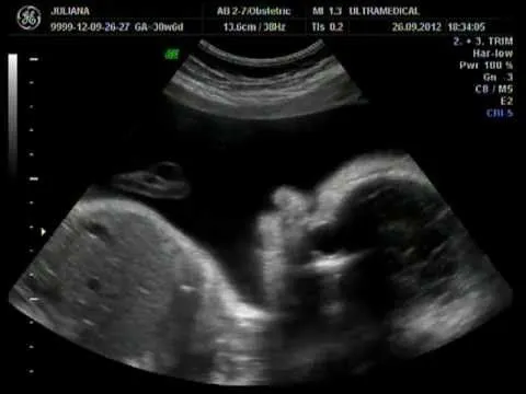 Ecografia doppler 31 semanas - Lucas Levi - YouTube Ecografia doppler 31 semanas - Lucas Levi - YouTube