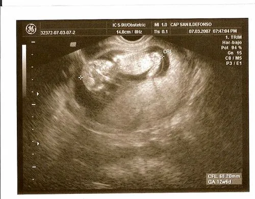 ecografia ecografia de nina ecografia ecografia de nina