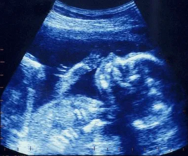 ECOGRAFIA DE EMBARAZO