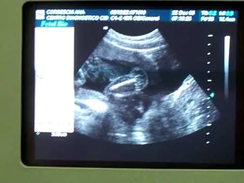 ECOGRAFIA EMBARAZO ANA 20 SEMANAS - YouTube ECOGRAFIA EMBARAZO ANA 20 SEMANAS - YouTube