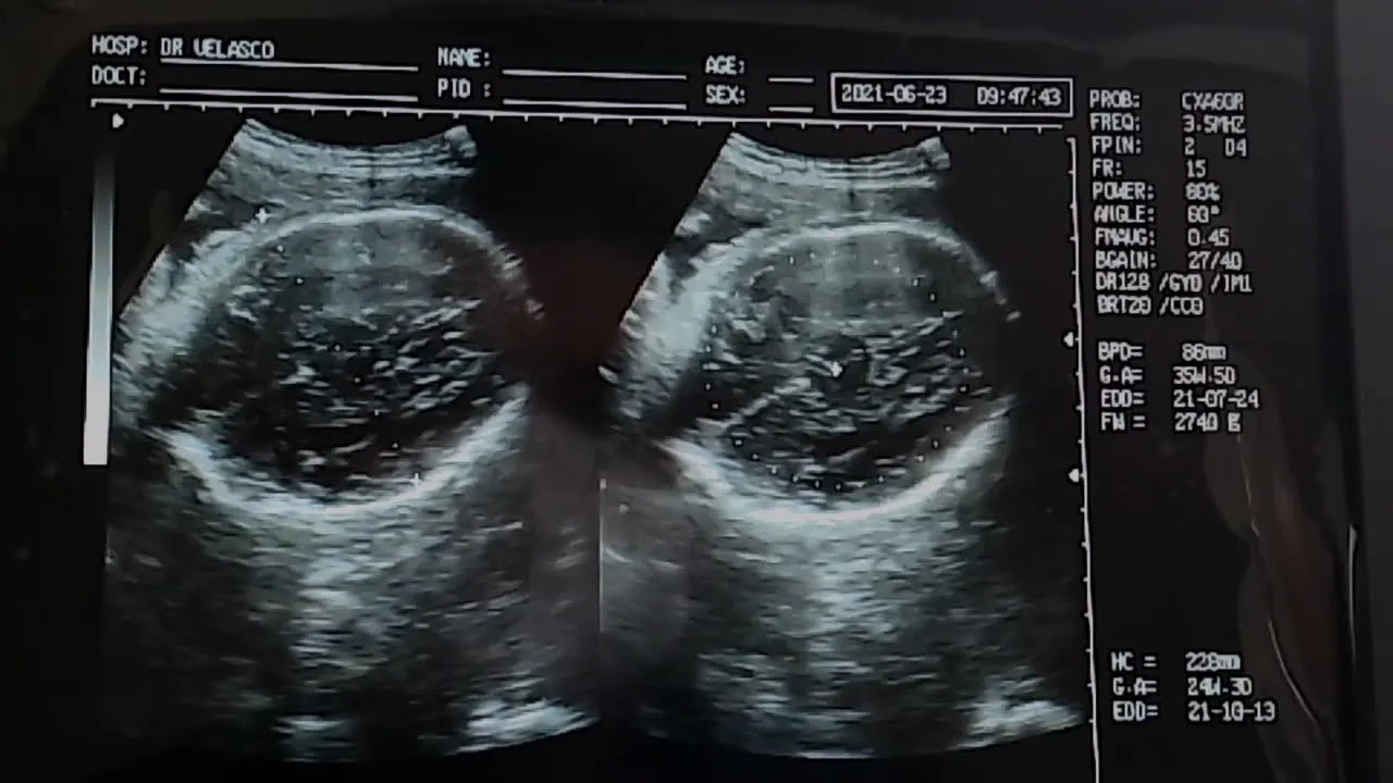 ECOGRAFÍA DE EMBARAZO GEMELAR DE FETOS MASCULINOS DE 35.0 SEMANAS DE GESTACIÓN - YouTube ECOGRAFÍA DE EMBARAZO GEMELAR DE FETOS MASCULINOS DE 35.0 SEMANAS DE GESTACIÓN - YouTube