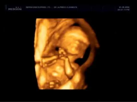 La segunda ecografía del embarazo - WorldNews