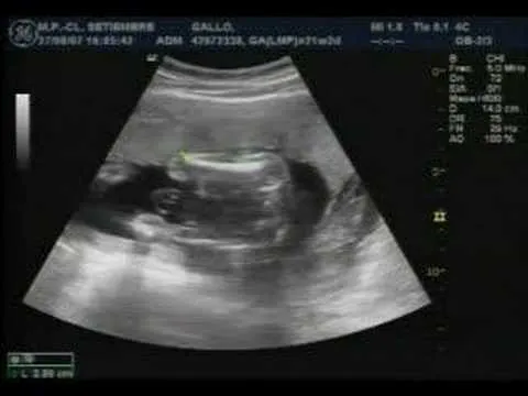 Ecografia estructural 22 semanas de Julieta - YouTube Ecografia estructural 22 semanas de Julieta - YouTube