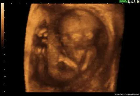 Ecografía con Feto de 17 Semanas - Fotos gratis de Ecografías 3D y ...