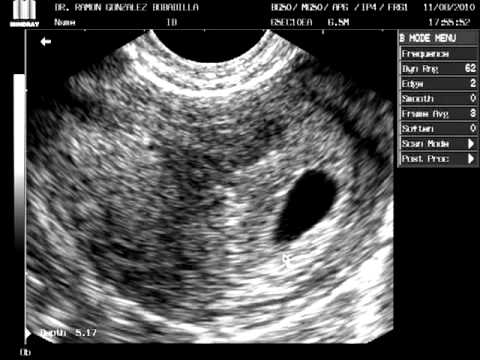 Ecografia de feto de 6 semanas - Imagui