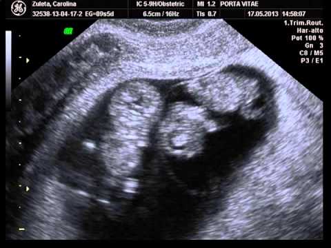 Ecografía gemelar 3d monocorial biamniotico 9 semanas y 5 días ... Ecografía gemelar 3d monocorial biamniotico 9 semanas y 5 días ...