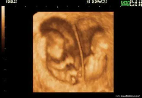 Ecografía de Gemelos de 10 Semanas | Vuestras Ecografías en 3D y ... Ecografía de Gemelos de 10 Semanas | Vuestras Ecografías en 3D y ...